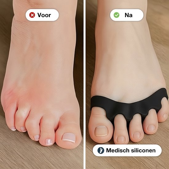 Alyze Teenspreider Siliconen - 2 Stuks - Hallux Valgus Corrector - Teenbeschermer - Tenenspreiders - Teencorrector - Hamerteen Brace - Grote teen - Persoonlijke Verzorging