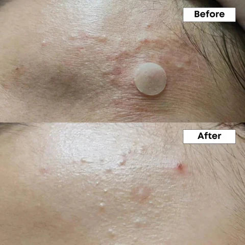 Nine Less A-Control 10% Azelaic Acid Serum – Intensieve Verzorging voor Onzuivere & Acnegevoelige Huid (2ml Sample)