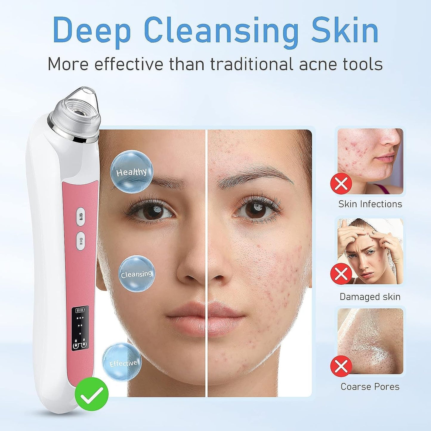 Ottleba Blackhead Remover Vacuum met 1080P HD-Camera – 17 × 4,5 × 4,5 cm – Lichtroze – Pore Cleaner met 3 Zuigstanden en 6 Opzetstukken