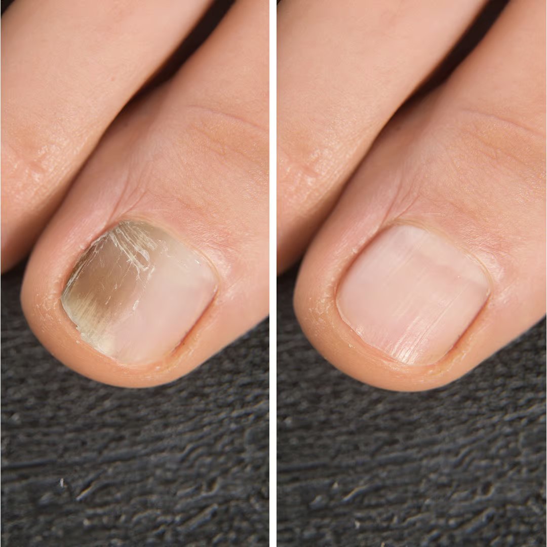 IZA Effect Voetschimmel- en Nagelsprayset - Snelle Toepassing - Zichtbaar Resultaat - 1+1 Gratis
