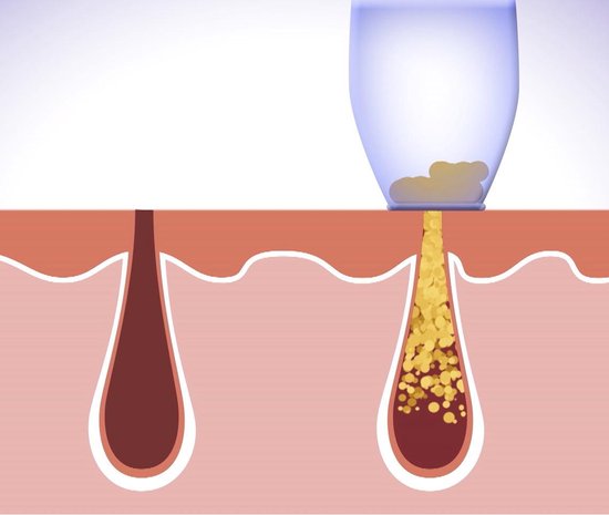 Derma Suction Dieptereiniging van de Huid en Poriën, Mee Eters Verwijderen, Mee Eter Verwijderaar, Gezichstreiniger, Elektrisch, Porienreiniger