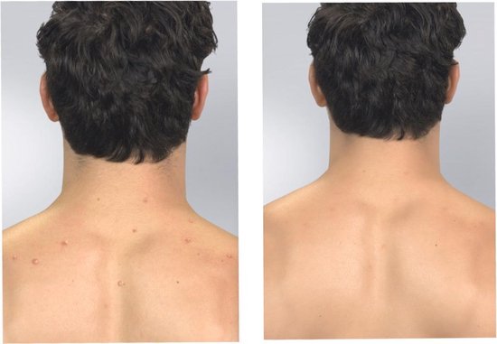 Derma Suction Dieptereiniging van de Huid en Poriën, Mee Eters Verwijderen, Mee Eter Verwijderaar, Gezichstreiniger, Elektrisch, Porienreiniger