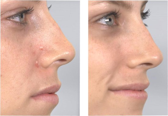 Derma Suction Dieptereiniging van de Huid en Poriën, Mee Eters Verwijderen, Mee Eter Verwijderaar, Gezichstreiniger, Elektrisch, Porienreiniger