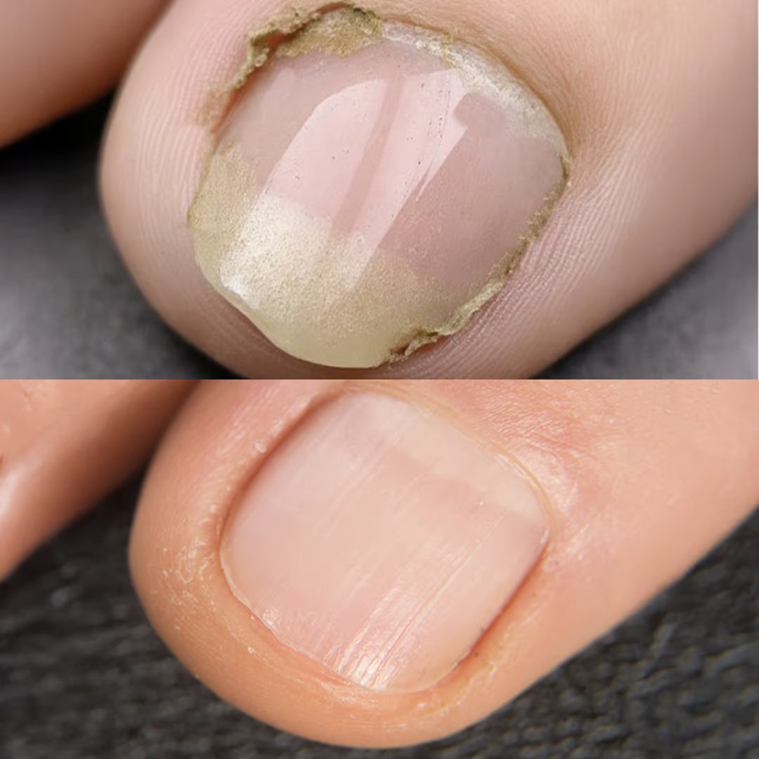 IZA Effect Voetschimmel- en Nagelsprayset - Snelle Toepassing - Zichtbaar Resultaat - 1+1 Gratis
