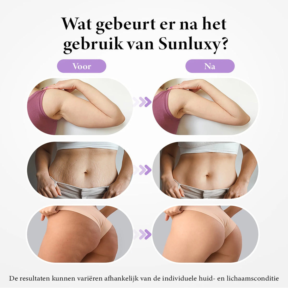 Sunluxy BCE1 Anti-Cellulitis Massageapparaat - EMS + Vacuüm + Rood Licht - 3 Standen voor Lichaam en Gezicht - Oplaadbaar - 19,4 x 17 x 7,8 cm
