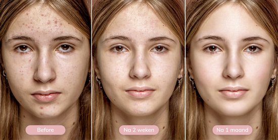 Vimora Mee-eters Verwijderaar – Gezichtsreiniger – Blackhead Remover – Puistjes & Acne – Mannen & Vrouwen